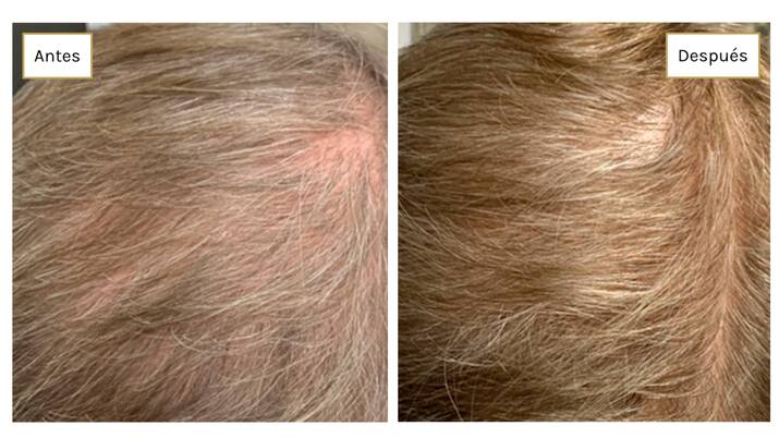 DSD de Luxe estudio clínico